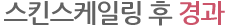 스킨스케일링 후 경과