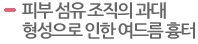 피부 섬유 조직의 과대 형성으로 인한 여드름 흉터 