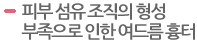 피부 섬유 조직의 형성 부족으로 인한 여드름 흉터  