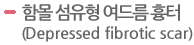 함몰 섬유형 여드름 흉터(Depressed fibrotic scar)  