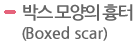 박스 모양의 흉터 (Boxed scar)  