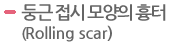 둥근 접시 모양의 흉터(Rolling scar)  