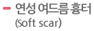 연성 여드름 흉터(Soft scar)  
