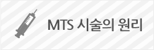 MTS 시술의 원리