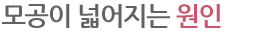모공이 넓어지는 원인