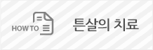 튼살의치료