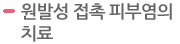 원발성 접촉 피부염의 치료