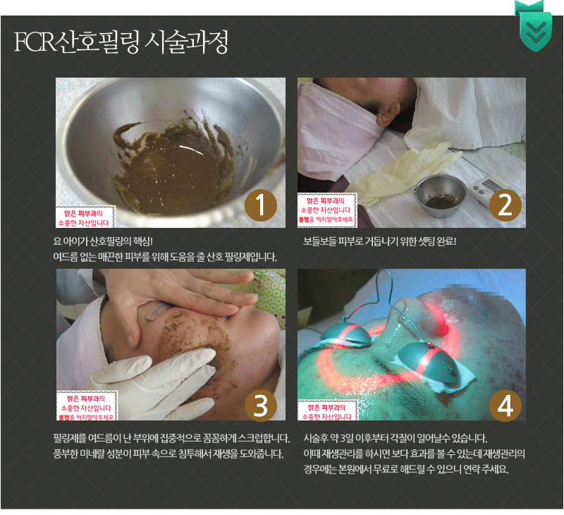  FCR 산호필링 시술과정