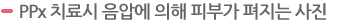 PPx 치료시 음압에 의해 피부가 펴지는 사진