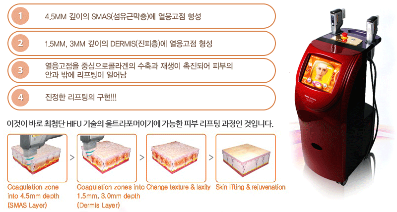 1. 4.5mm 깊이의 SMAS(섬유근막층)에 열응고점 형성 / 2. 1.5mm, 3mm 깊이의 Dermis(진피층)에 열응고점 형성 / 3. 열응고점을 중심으로콜라겐의 수축과 재생이 촉진되어 피부의 안과 밖에 리프팅이 일어남 / 4. 진정한 리프팅의 구현!!! / 이것이 바로 최첨단 HIFU 기술의 울트라포머이기에 가능한 피부 리프팅 과정인 것입니다.
