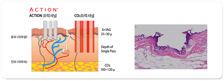 Er:YAG 레이저의 특성