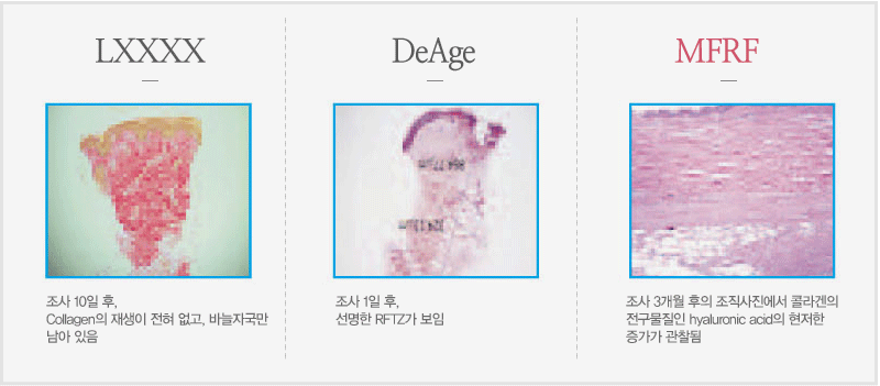 LXXXX : 조사 10일 후,Collagen의 재생이 전혀 없고, 바늘자국만 남아 있음 / DeAge : 조사 1일 후,선명한 RFTZ가 보임 / MFRF :조사 3개월 후의 조직사진에서 콜라겐의 전구물질인 hyaluronic acid의 현저한 증거가 관찰됨