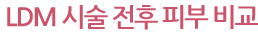 LDM 시술 전후 피부 비교